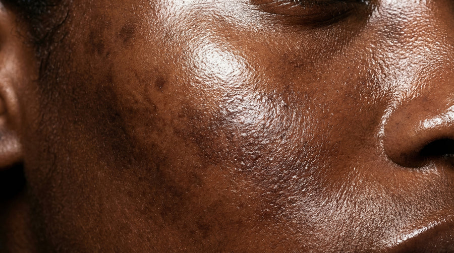 Hyperpigmentation