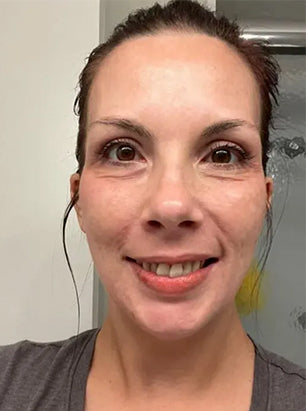 Customer skin before using Skin Clinic