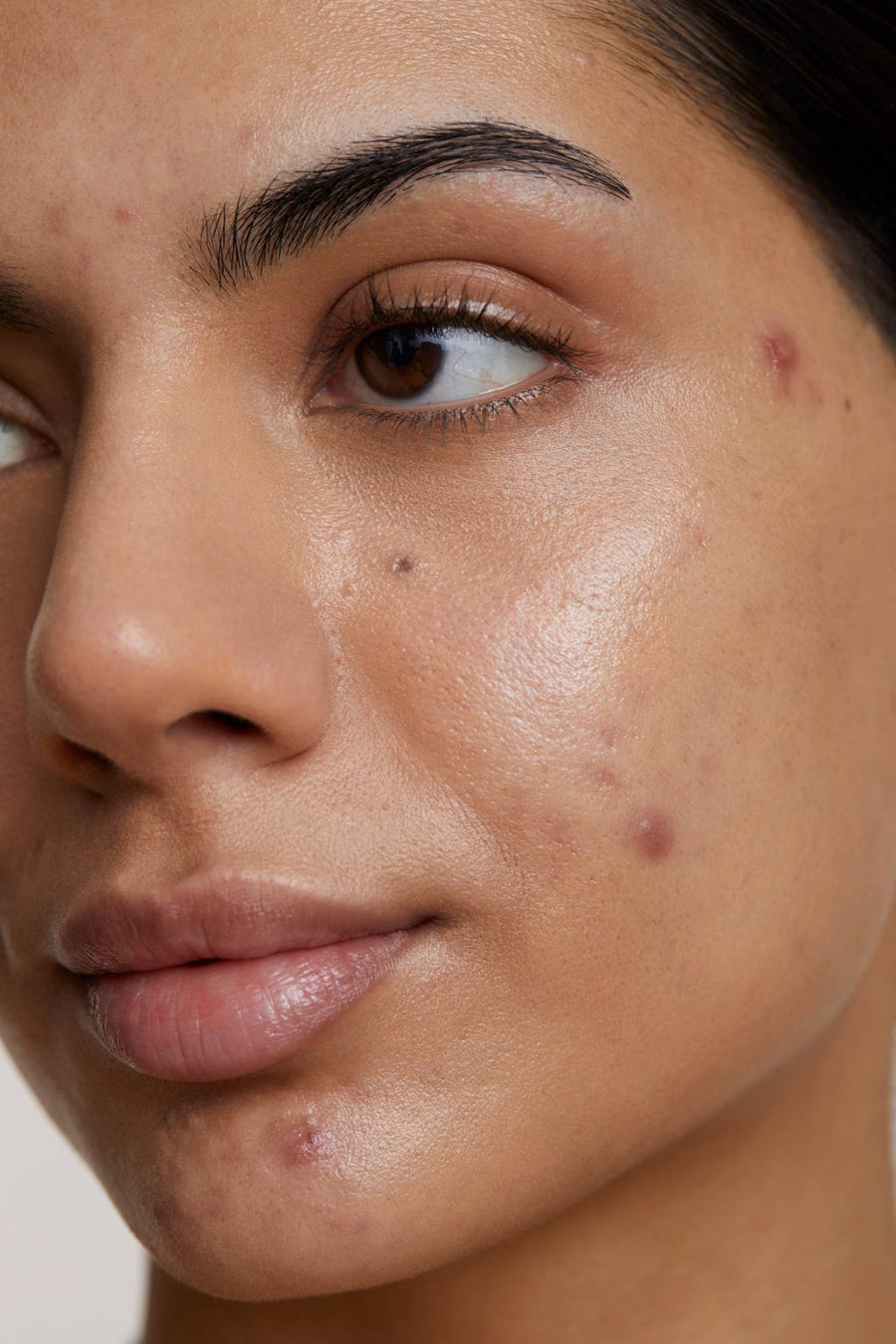 Acne & Blemishes