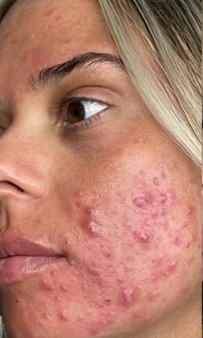 Customer skin before using Skin Clinic