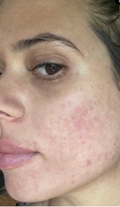 Customer skin after using Skin Clinic
