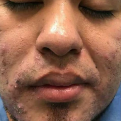 Customer skin before using Skin Clinic