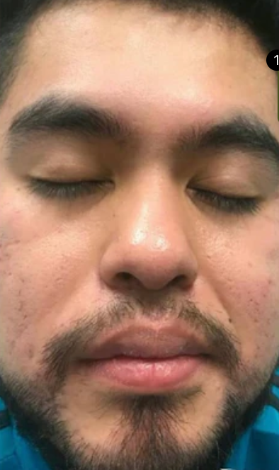 Customer skin after using Skin Clinic