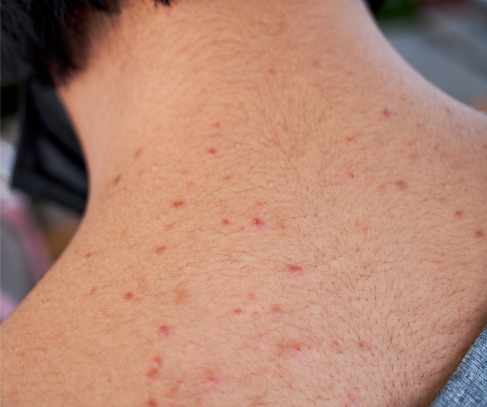 Amber's back before, back acne