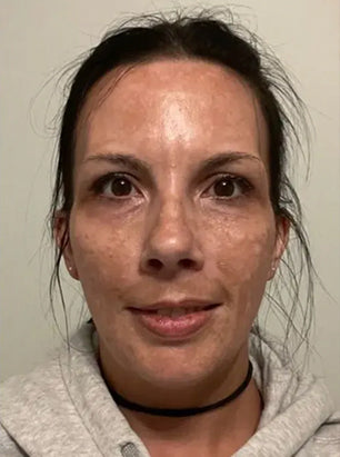 Customer skin after using Skin Clinic