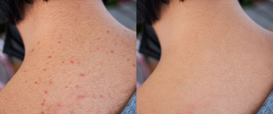 Body Acne
